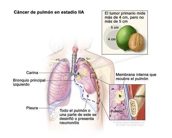 Cáncer de pulmón en estadio IIA. En la imagen se observa un tumor primario en el pulmón izquierdo que mide más de 4 cm, pero no más de 5 cm. Además se observan las siguientes situaciones: a)  el cáncer se diseminó al bronquio principal izquierdo; b) el cáncer se diseminó a la membrana interna que recubre el pulmón (recuadro inferior); c) todo el pulmón o una parte de este se desinfló o presenta neumonitis (inflamación del pulmón). También se observan la carina y la pleura y, en el recuadro inferior, una costilla.
