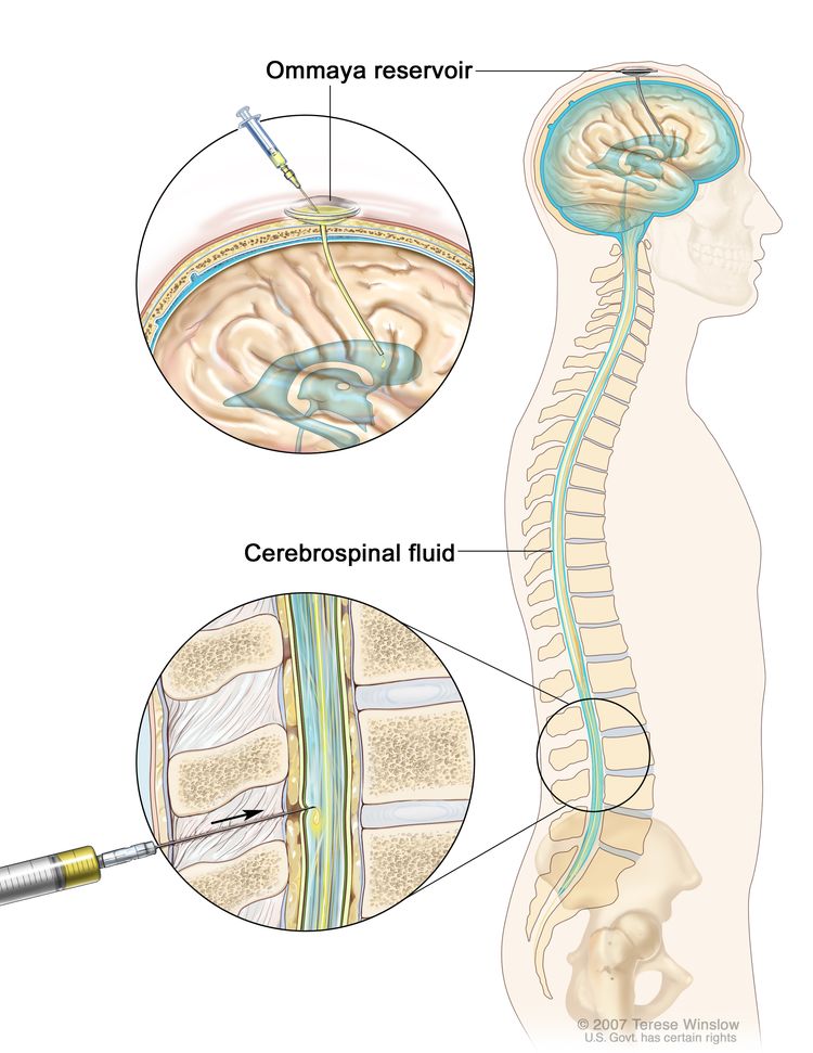 العلاج الكيميائي داخل القراب.  يُظهر الرسم السائل النخاعي (CSF) في الدماغ والحبل الشوكي ، وخزان أومايا (وعاء على شكل قبة يوضع تحت فروة الرأس أثناء الجراحة ؛ يحمل الأدوية أثناء تدفقها عبر أنبوب صغير إلى الدماغ).  يُظهر القسم العلوي حقنة وإبرة تحقن أدوية مضادة للسرطان في خزان أومايا.  يُظهر القسم السفلي حقنة وإبرة تحقن الأدوية المضادة للسرطان مباشرة في السائل النخاعي في الجزء السفلي من العمود الفقري.
