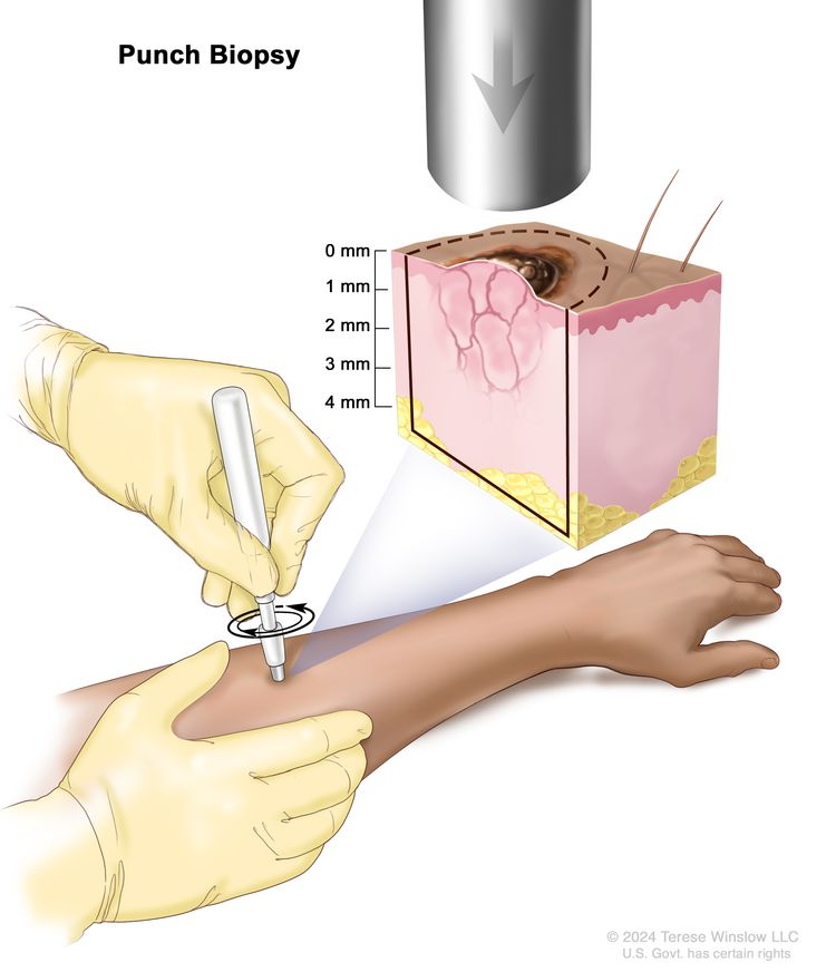 Punch biopsy; drawing shows a sharp, hollow, circular instrument being inserted into a lesion on the skin of a patient’s forearm. The instrument is turned clockwise and counterclockwise to cut into the skin and remove a small, round piece of tissue. A pullout shows that the instrument cuts about 4 millimeters (mm) down to the layer of fatty tissue below the skin.