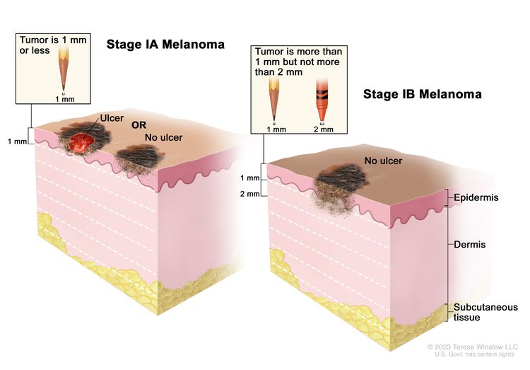 Two-panel drawing of stage I melanoma; the panel on the left shows a stage IA tumor that is not more than 1 millimeter thick, with ulceration (a break in the skin) and without ulceration. The panel on the right shows a stage IB tumor that is more than 1 but not more than 2 millimeters thick, without ulceration. Also shown are the epidermis (outer layer of the skin), the dermis (inner layer of the skin), and the subcutaneous tissue below the dermis.