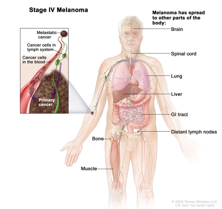 Stage IV melanoma; drawing shows other parts of the body where melanoma may spread, including the brain, spinal cord, lung, liver, gastrointestinal (GI) tract, bone, muscle, and distant lymph nodes. An inset shows cancer cells spreading through the blood and lymph system to another part of the body where a metastatic tumor has formed.
