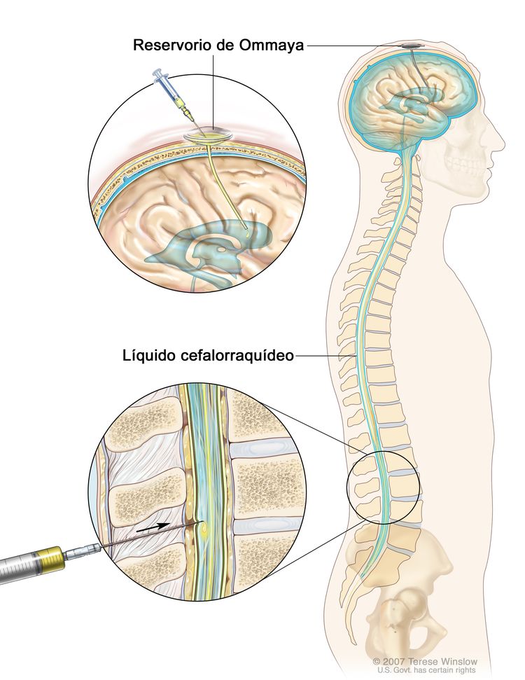 Quimioterapia intratecal; la imagen muestra el líquido cefalorraquídeo (LCR) en el cerebro y la médula espinal, y un reservorio (depósito) de Ommaya (un aparato en forma de cúpula que se coloca debajo del cuero cabelludo mediante cirugía; este contiene los medicamentos que circulan por un tubo delgado hasta el cerebro). En la sección superior se muestra una jeringa con la que se inyectan medicamentos contra el cáncer en el reservorio de Ommaya. En la sección inferior se muestra una jeringa con la que se inyectan medicamentos contra el cáncer directamente en el LCR en la parte inferior de la columna vertebral.