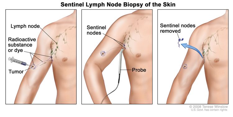 Sentinel lymph node biopsy of the skin. The first of three panels shows a radioactive substance and/or blue dye injected near the tumor; the middle panel shows that the injected material is followed visually and/or with a probe that detects radioactivity to find the sentinel nodes (the first lymph nodes to take up the material); the third panel shows the removal of the tumor and the sentinel nodes to check for cancer cells.