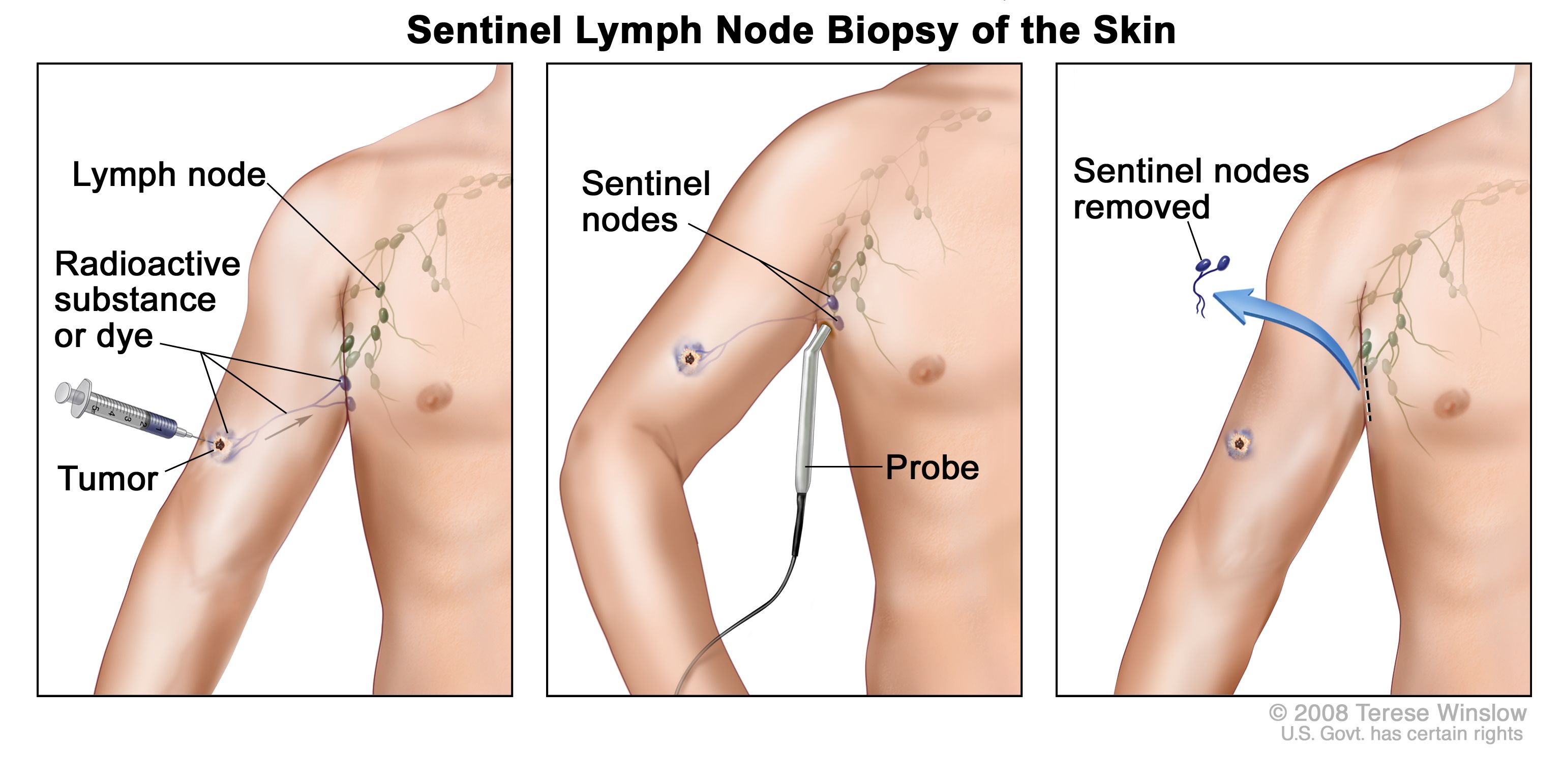 neuroendocrine cancer of the skin