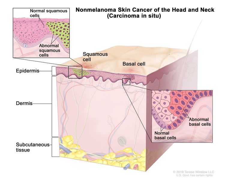 Nemelanomski kožni rak glave in vratu (karcinom in situ);  risba prikazuje nenormalne skvamozne celice in bazalne celice v povrhnjici.  Prikazani so tudi dermis in podkožje pod dermisom.  Obstajata dve osebi: vstavki na levi kažejo na zapiranje normalnih in nenormalnih skvamoznih celic;  vstavki na desni kažejo zapiranje normalnih in nenormalnih bazalnih celic.