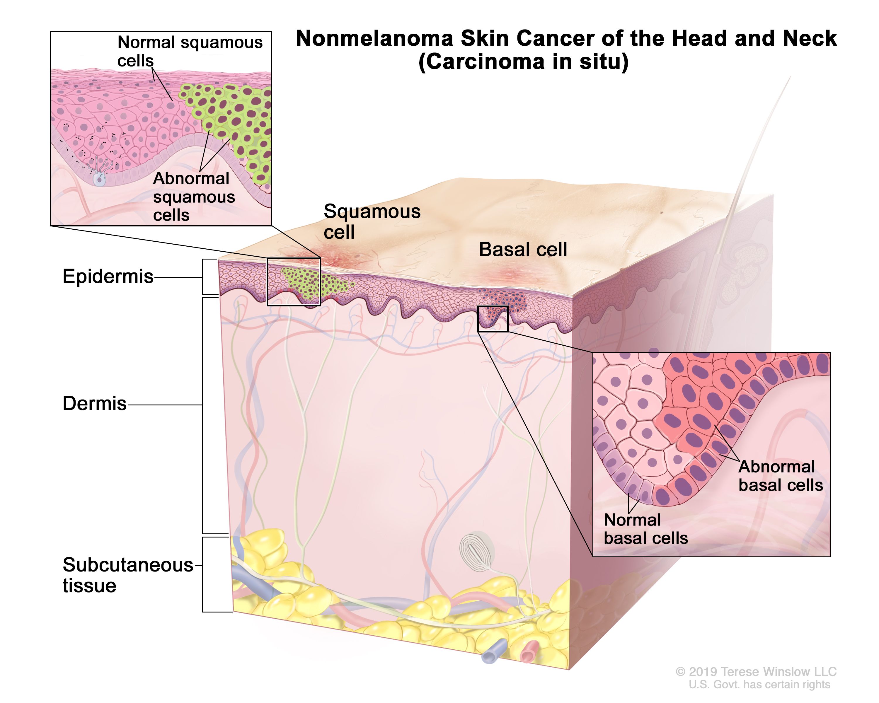 skin cancer types basal cell carcinoma