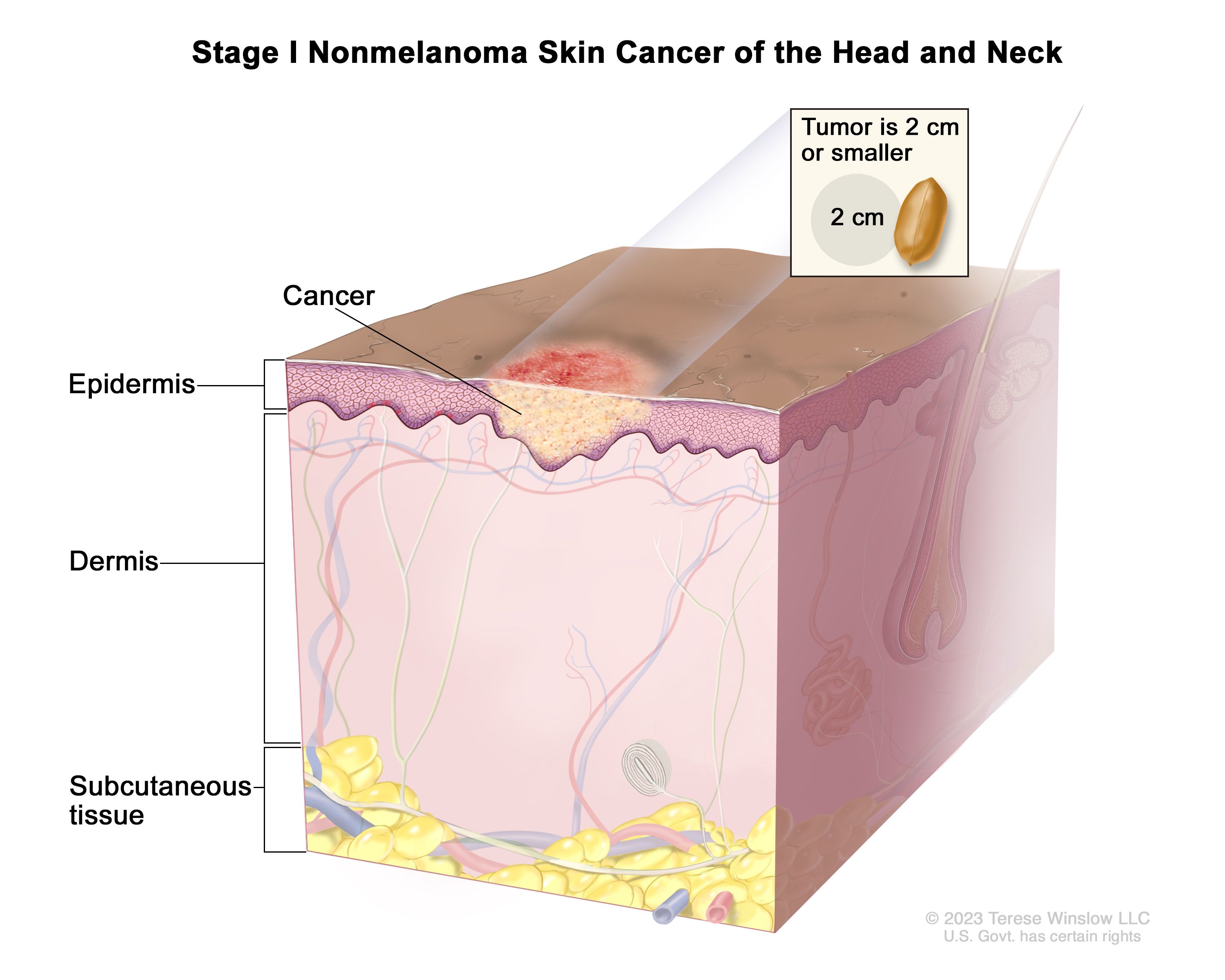 Body Location May Influence Tumor Formation - NCI