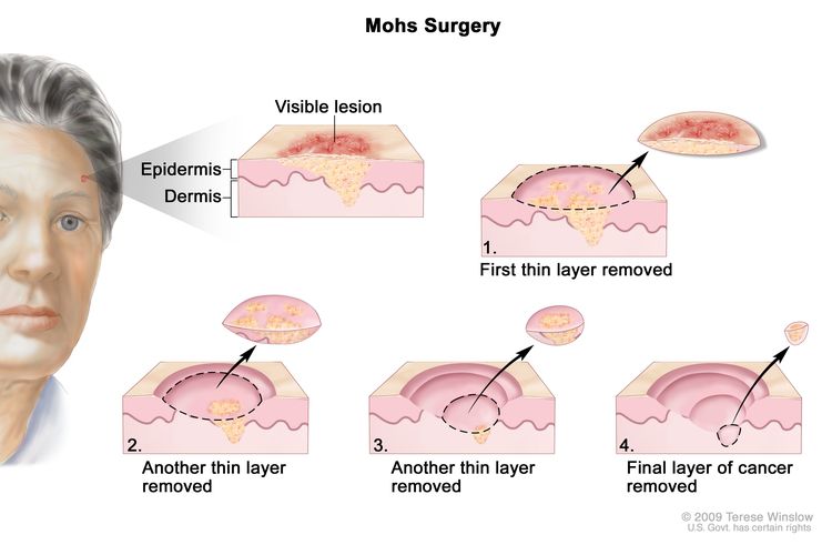 Mohs surgery; drawing shows a patient with skin cancer on the face. The pullout shows a block of skin with cancer in the epidermis (outer layer of the skin) and the dermis (inner layer of the skin). A visible lesion is shown on the skin’s surface. Four numbered blocks show the removal of thin layers of the skin one at a time until all the cancer is removed.