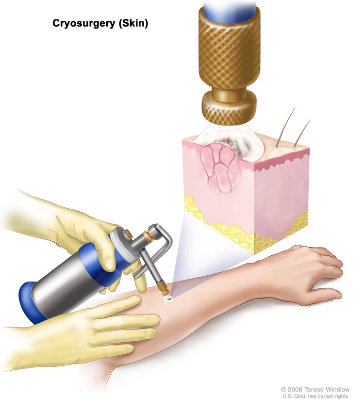 Kriokirurgija;  risba prikazuje instrument z šobo, ki se drži nad nenormalnim območjem na spodnji roki pacienta.  Inset kaže razprševanje tekočega dušika ali tekočega ogljikovega dioksida, ki prihaja iz šobe in pokriva nenormalno lezijo.  Zamrzovanje uniči lezijo.