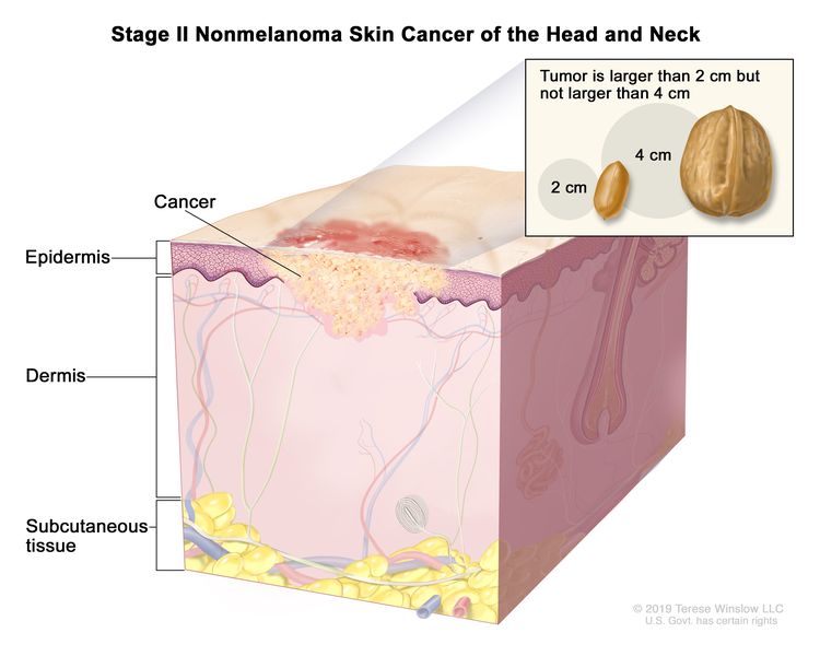 Stage II nemelanomski kožni rak glave in vratu;  risba prikazuje raka v povrhnjici in dermisu.  Vstavljanje kaže, da je tumor večji od 2 centimetra, vendar ne večji od 4 centimetrov in da je 2 centimetra približno velikost arašida, 4 centimetri pa približno velikost oreha.  Prikazano je tudi podkožje pod dermisom.