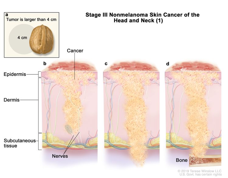 Stage III nemelanomski kožni rak glave in vratu (1);  risba prikazuje (a) vložek, ki kaže, da je tumor večji od 4 centimetrov in da je 4 centimetra približno velikost oreha.  Prikaže se tudi rak, ki se širi skozi povrhnjico do (b) tkiva, ki pokriva živce pod dermisom;  (c) pod podkožjem;  in (d) kosti.