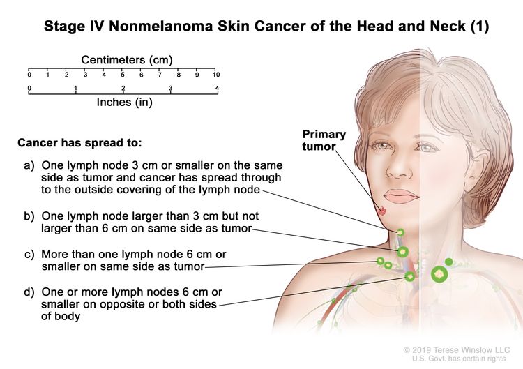 Stage IV nemelanomski kožni rak glave in vratu (1);  na risbi je prikazan primarni tumor na obrazu in rak, ki se je razširil na: (a) eno bezgavko na isti strani telesa kot tumor, vozlišče je 3 centimetre ali manj in rak se je razširil na zunanjo prevleko bezgavka;  (b) eno bezgavko na isti strani telesa kot tumor in vozlišče je večje od 3 centimetrov, vendar ne večje od 6 centimetrov;  (c) več kot eno bezgavko na isti strani telesa kot tumor in vozlišča so 6 centimetrov ali manj;  in (d) eno ali več bezgavk na nasprotni ali obeh straneh telesa, saj sta tumor in vozlišča 6 centimetrov ali manj.  Prikazana sta tudi 10-centimetrska ravnila in 4-palčna ravnila.