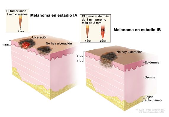 Dibujo de dos paneles del melanoma en estadio I. En el panel de la izquierda se observa un tumor en estadio IA que no mide más de 1 mm de grosor, y hay ulceración (rotura de la piel) o no hay ulceración. En el panel de la derecha se observa un tumor en estadio IB que mide más de 1 mm pero no más de 2 mm y no hay ulceración. También se muestran la epidermis (capa superficial o externa de la piel), la dermis (capa profunda o interna de la piel) y el tejido subcutáneo debajo de la dermis.