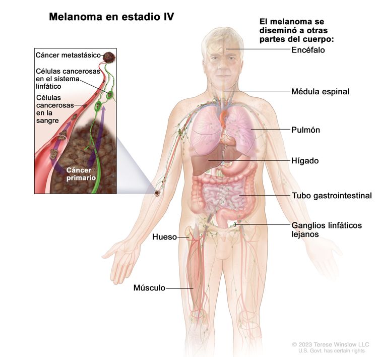 Melanoma en estadio IV. En el dibujo se observan otras partes del cuerpo donde es posible que se disemine el melanoma, como el encéfalo, la médula espinal, el pulmón, el hígado, el tubo gastrointestinal, el hueso, el músculo y los ganglios linfáticos lejanos. En un recuadro se muestran células cancerosas que se diseminan a través de la sangre y el sistema linfático a otra parte del cuerpo donde se formó un tumor metastásico.
