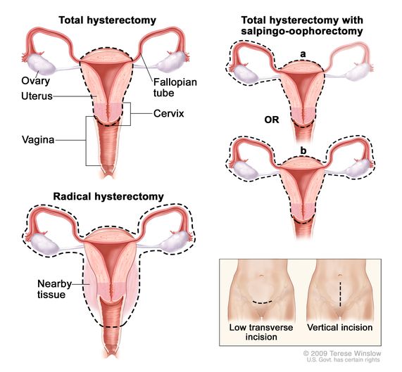 Ovarian cancer with hysterectomy