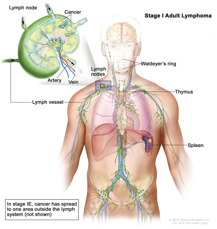Stage I adult lymphoma; drawing shows cancer in one lymph node group and in the spleen. Also shown are the Waldeyer’s ring and the thymus. An inset shows a lymph node with a lymph vessel, an artery, and a vein. Cancer cells are shown in the lymph node.