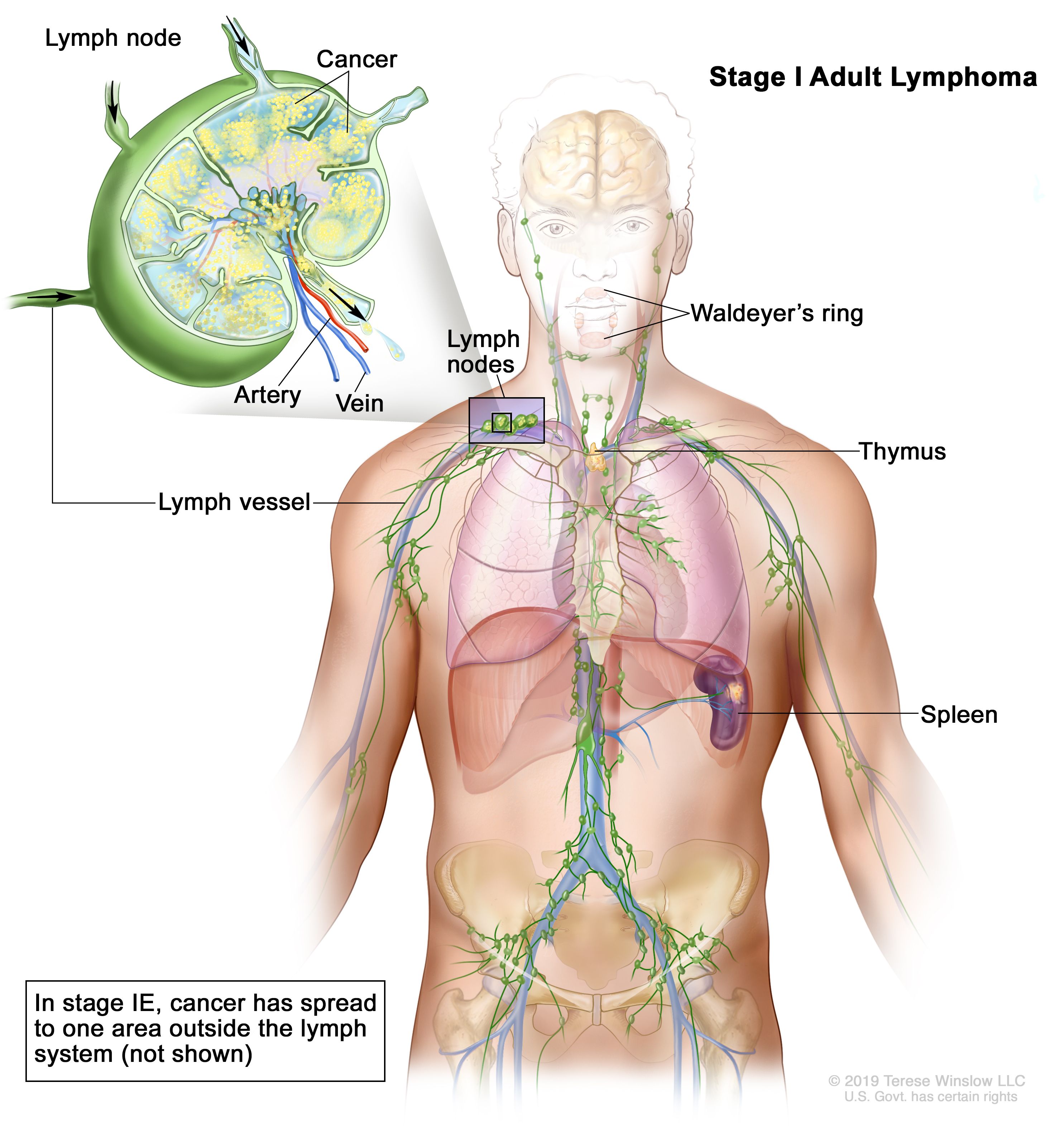 Gral Medical - Formele de cancer ale sistemului limfatic Hodgkin si Non Hodgkin