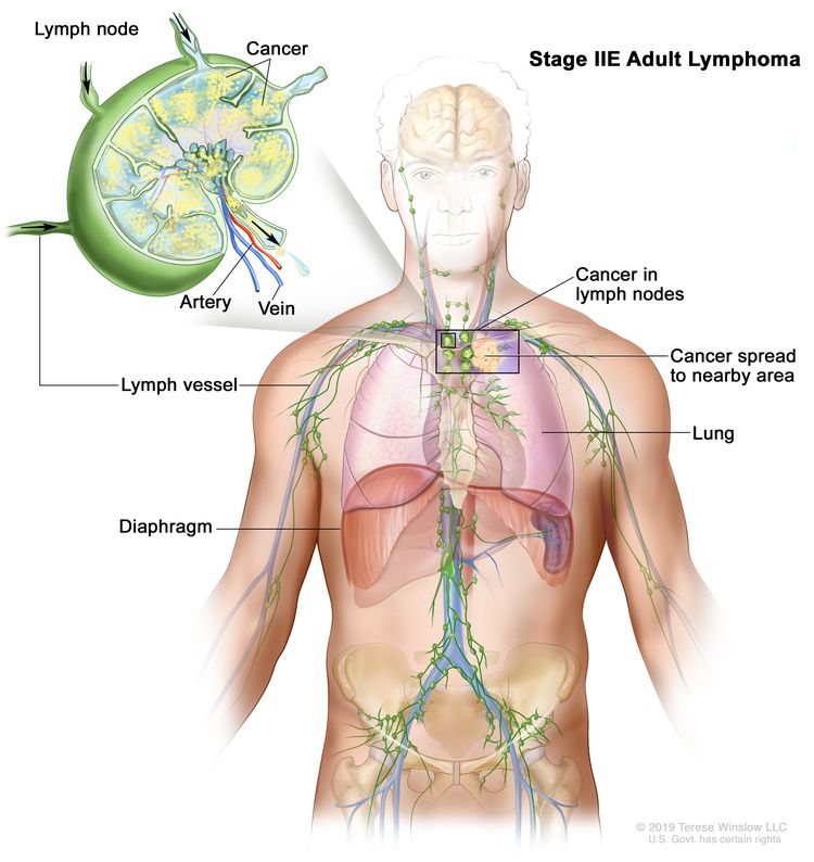 Stage IIE adult lymphoma; drawing shows cancer that has spread from a group of lymph nodes to a nearby area. Also shown is a lung and the diaphragm. An inset shows a lymph node with a lymph vessel, an artery, and a vein. Cancer cells are shown in the lymph node.