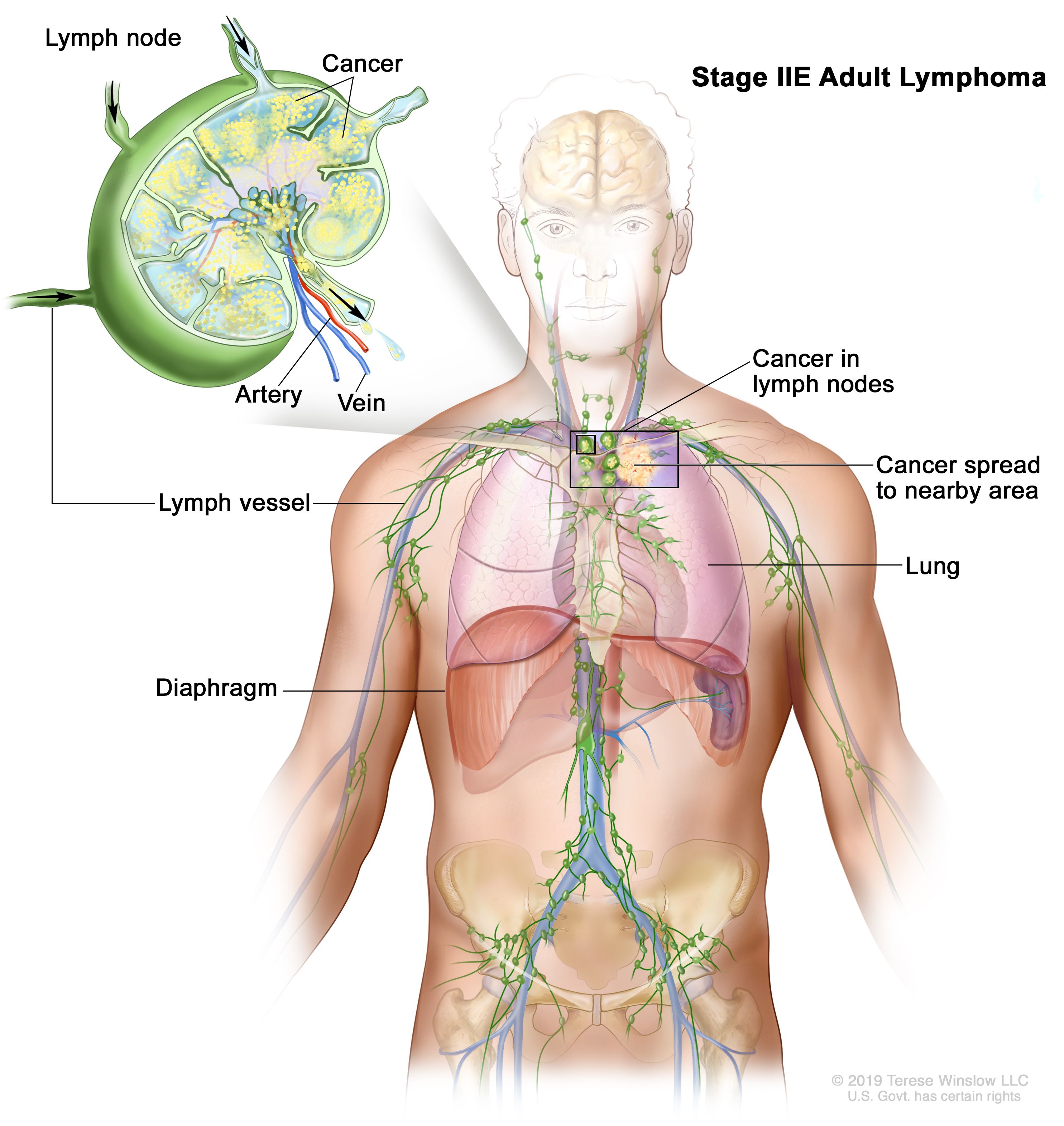 Hodgkin Lymphoma Vanderbilt Ingram Cancer Center