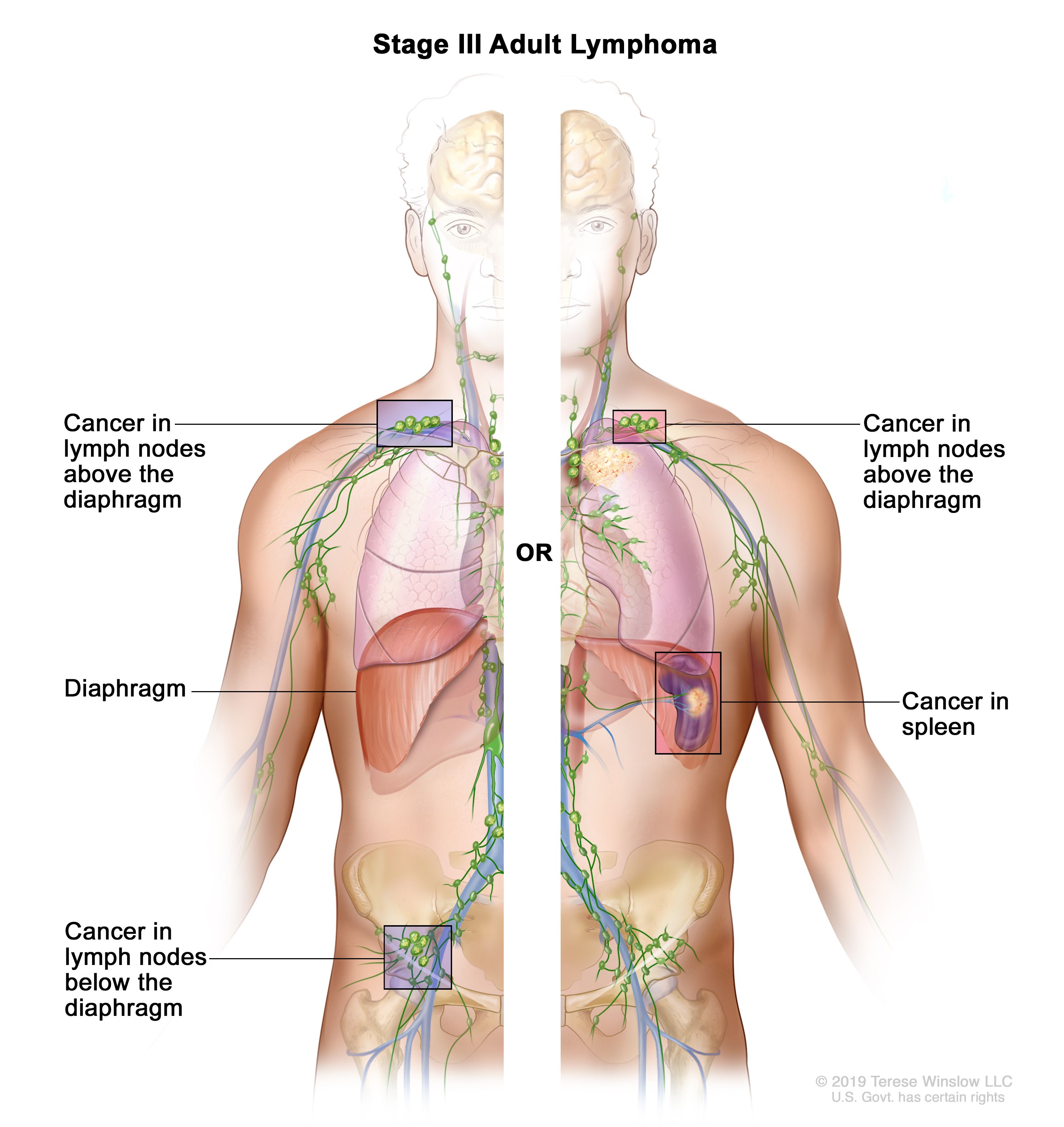 Lymphoma left side cancer 2025 lymph nodes in neck