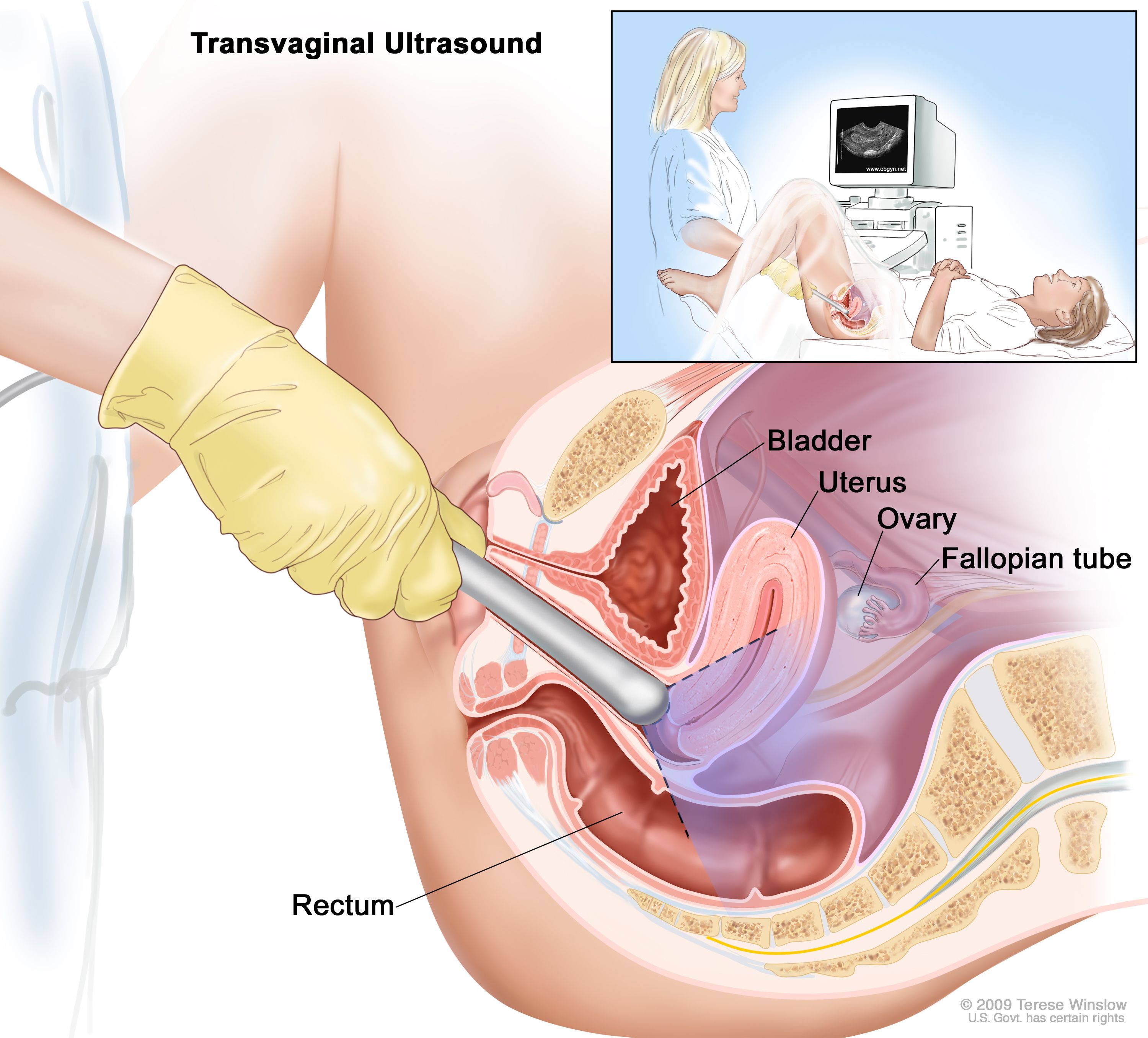 Endometrial cancer in premenopausal. Viermi julia nachalova, Endometrial cancer detection