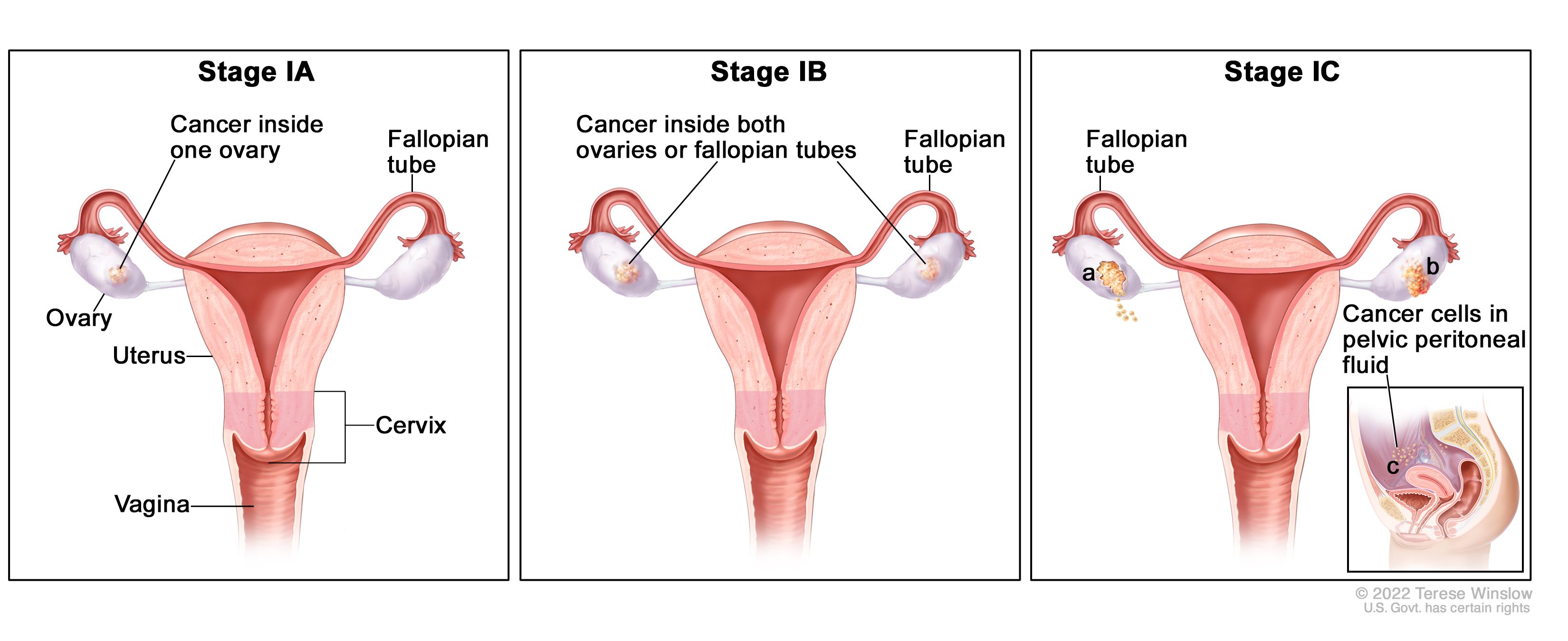 ovarian cancer is epithelial