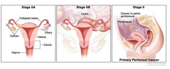 Peritoneal cancer from colon