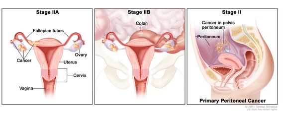 Definition of stage II ovarian epithelial, fallopian tube, and primary  peritoneal cancer - NCI Dictionary of Cancer Terms - NCI