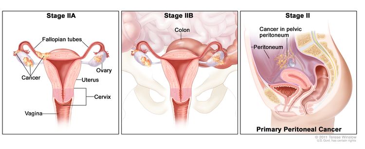 Three-panel drawing of stage IIA, IIB, and stage II primary peritoneal cancer; the first panel (stage IIA) shows cancer inside both ovaries that has spread to the uterus and fallopian tube. The second panel (stage IIB) shows cancer inside both ovaries that has spread to the colon. The third panel (stage II primary peritoneal cancer) shows cancer in the pelvic peritoneum. Also shown are the cervix and vagina.