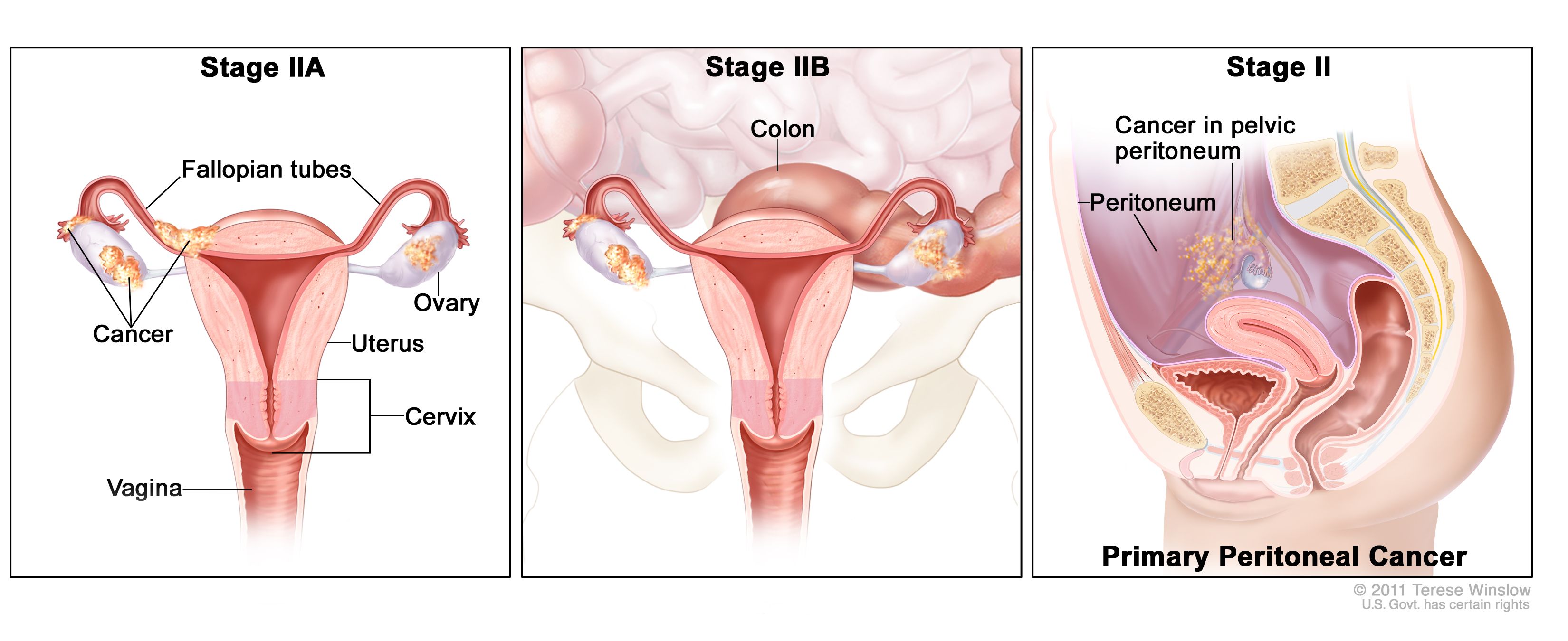 Definition of stage II ovarian epithelial, fallopian tube, and primary  peritoneal cancer - NCI Dictionary of Cancer Terms - NCI