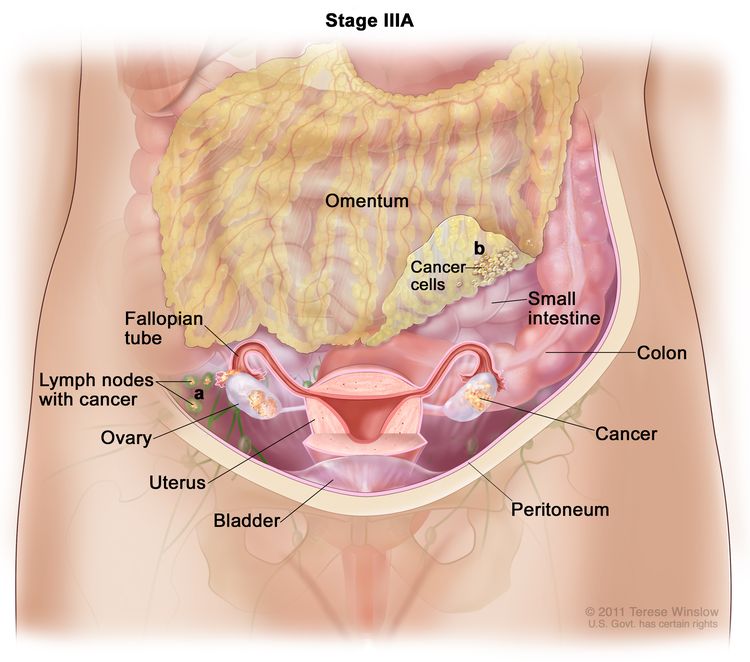 Drawing of stage IIIA shows cancer inside both ovaries that has spread to (a) lymph nodes behind the peritoneum and (b) the omentum. The small intestine, colon, fallopian tubes, uterus, and bladder are also shown.