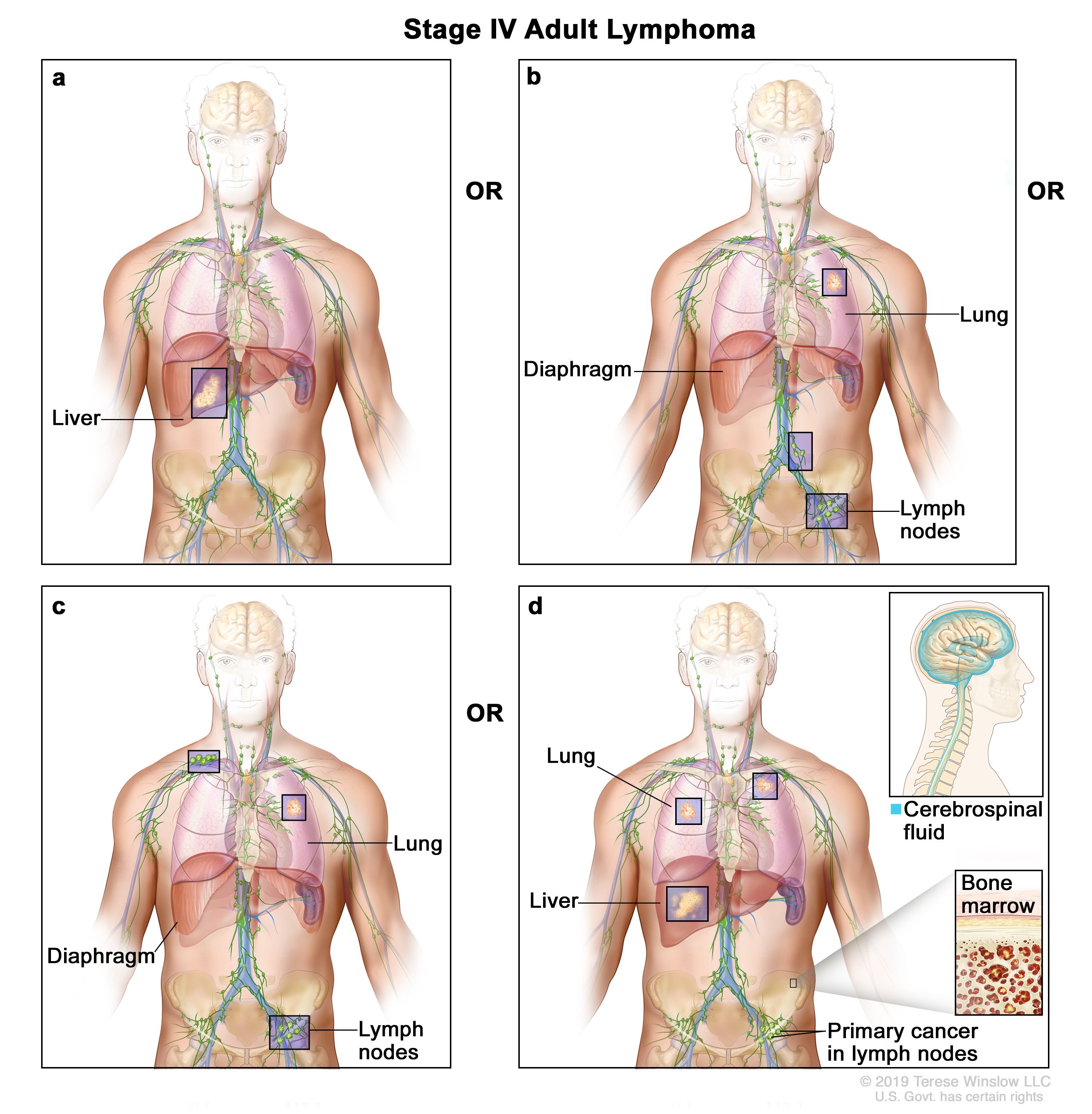 Can you live a normal life with lymphoma