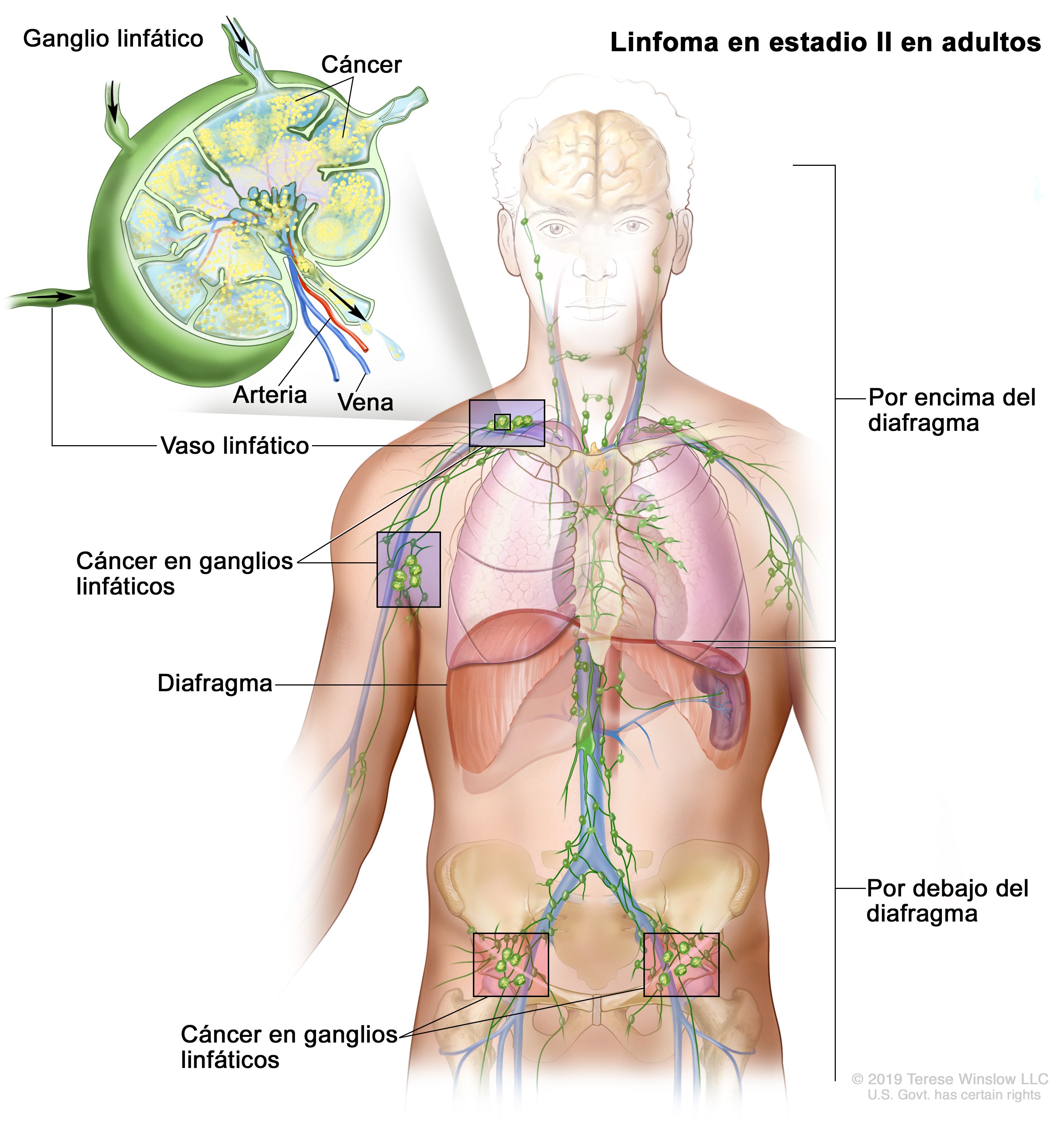 cancer hodgkin linfatico giardiaza limbii