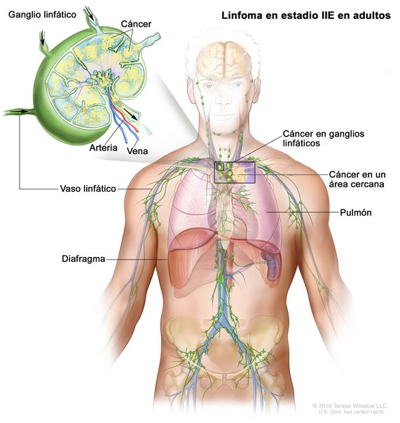 Linfoma en estadio IIE en adultos. En el dibujo se muestra cáncer que se diseminó desde un grupo de ganglios linfáticos hasta un área cercana en el centro del tórax. También se muestran un pulmón y el diafragma. En una ampliación, se observan un ganglio linfático con células cancerosas, un vaso linfático, una arteria y una vena.