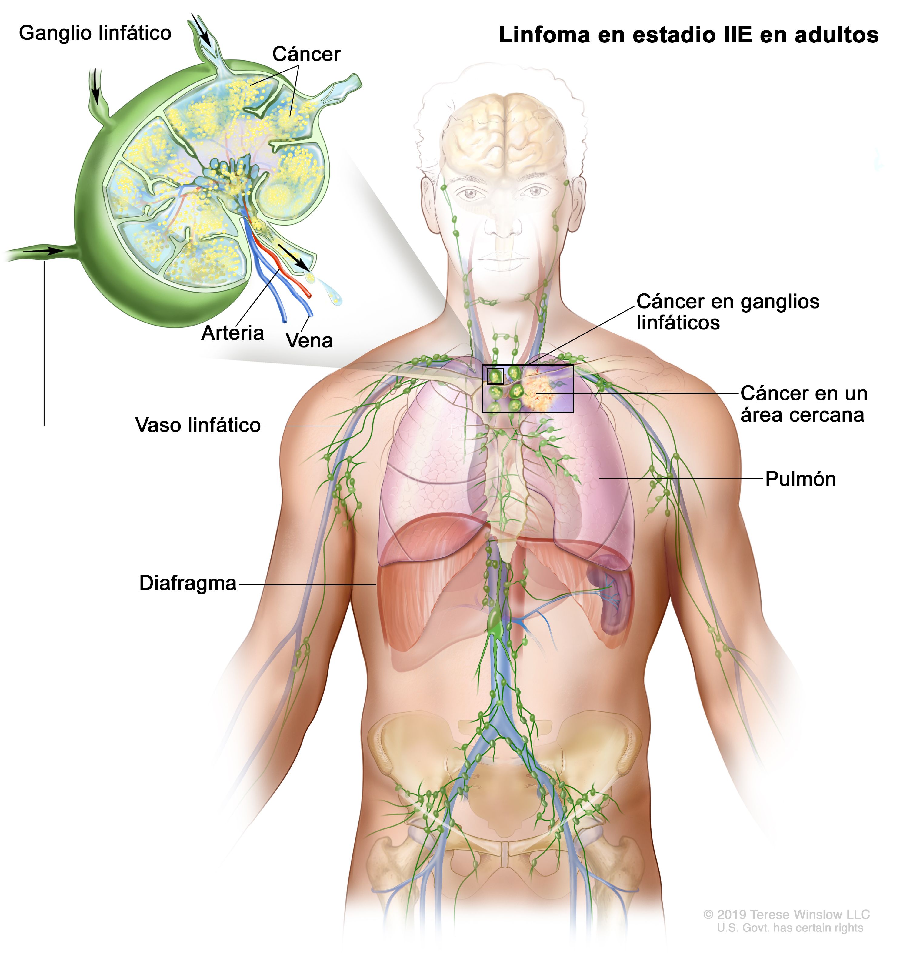 Cancer de hodgkin, Difteria – Corynebacterium diphteriae - Cancer linfatico hodgkin sintomas