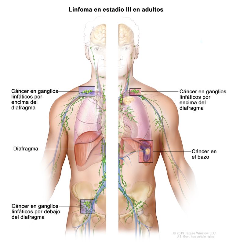 Linfoma en estadio III en adultos. En el dibujo se observan el lado derecho y el lado izquierdo del cuerpo. En el lado derecho del cuerpo, se muestra cáncer en grupos de ganglios linfáticos por encima y por debajo del diafragma. En el lado izquierdo del cuerpo, se muestra cáncer en un grupo de ganglios linfáticos por encima del diafragma y en el bazo.
