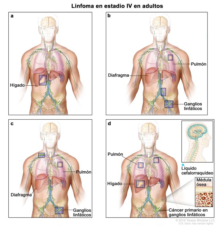 Linfoma en estadio IV en adultos. En el dibujo se observan cuatro paneles: en el panel ubicado en la parte superior izquierda, se muestra cáncer en el hígado; en el panel b superior derecho, se muestra cáncer en el pulmón izquierdo y en 2 grupos de ganglios linfáticos por debajo del diafragma; en el panel c inferior izquierdo, se muestra cáncer en el pulmón izquierdo y en grupos de ganglios linfáticos por encima y por debajo del diafragma; en el panel d inferior derecho, se muestra cáncer en ambos pulmones y el hígado, y el cáncer primario en ganglios linfáticos cerca de la cadera. En un recuadro de este mismo panel, se observa una ampliación de un cáncer en la médula ósea. También se muestra una ampliación del encéfalo y el líquido cefalorraquídeo de color azul.