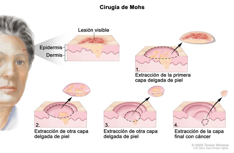 Cirugía de Mohs. En la imagen se observa un paciente con cáncer de piel en la cara. En la ampliación se muestra un trozo de piel con un cáncer en la epidermis (capa exterior de la piel) y la dermis (capa interna de la piel). También se muestra una lesión visible en la superficie de la piel. En cuatro ampliaciones numeradas se observa la extracción de capas delgadas de la piel, una por una hasta que se termina de extirpar todo el cáncer.