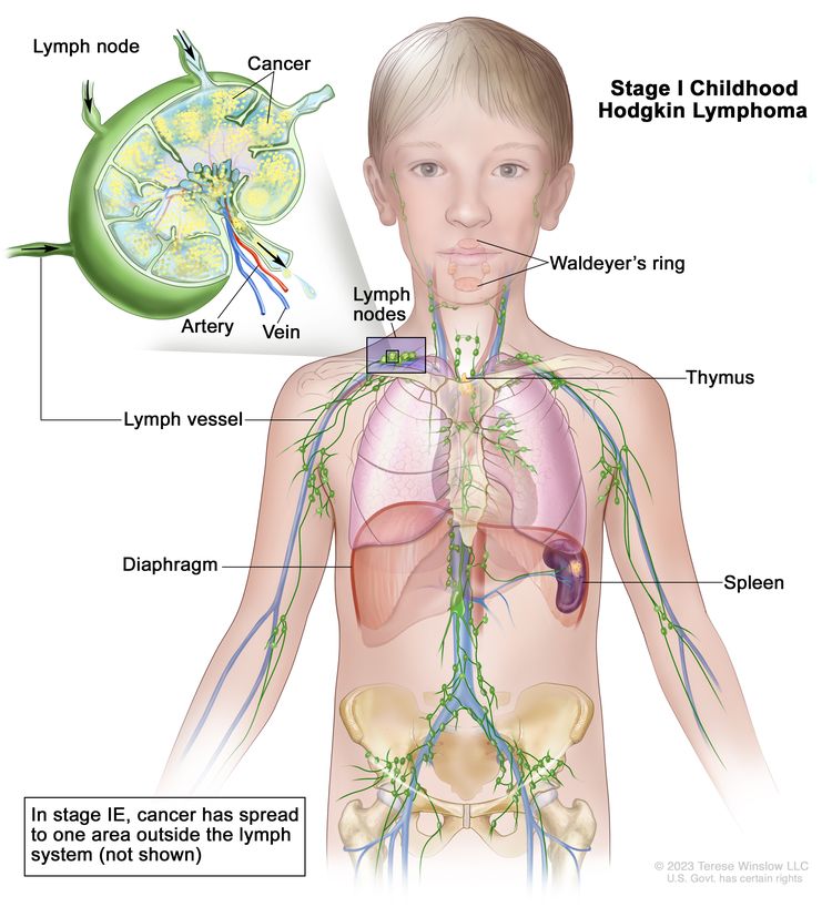 Stage I childhood Hodgkin lymphoma; drawing shows cancer in one lymph node group above the diaphragm and in the spleen. Also shown are the Waldeyer’s ring and the thymus. An inset shows a lymph node with a lymph vessel, an artery, and a vein. Cancer cells are shown inside the lymph node.
