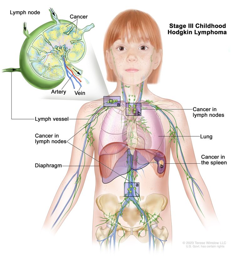 Stage III childhood Hodgkin lymphoma; drawing shows cancer in lymph node groups above and below the diaphragm (a). Also shown is cancer that has spread outside the lymph nodes to a nearby area in the left lung (b) and cancer that has spread to the spleen (c). An inset shows a lymph node with a lymph vessel, an artery, and a vein. Cancer cells are shown inside the lymph node.