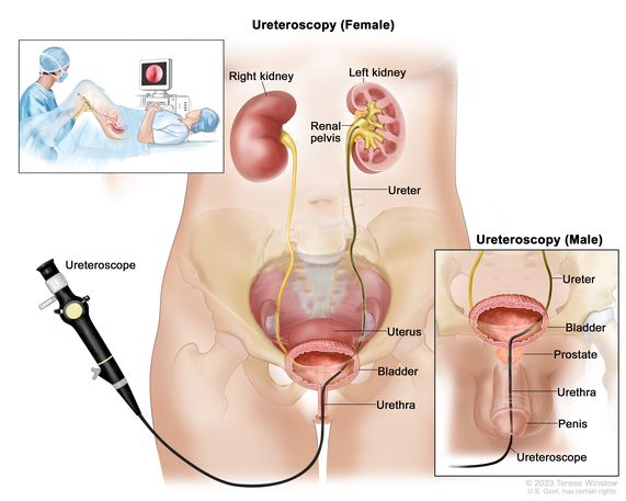 Ureter Ureter Reconstruction