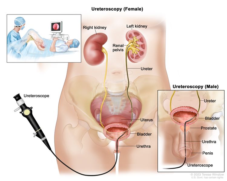 Ureteroscopy; drawing shows the lower pelvis containing the right and left kidneys, ureter, bladder, and urethra. The flexible tube of a ureteroscope (a thin, tube-like instrument with a light and a lens for viewing) is shown passing through the urethra into the bladder and ureter. An inset shows a woman lying on an examination table with her knees bent and legs apart. She is covered by a drape. The doctor looks at an image of the inside of the ureter on a computer monitor.
