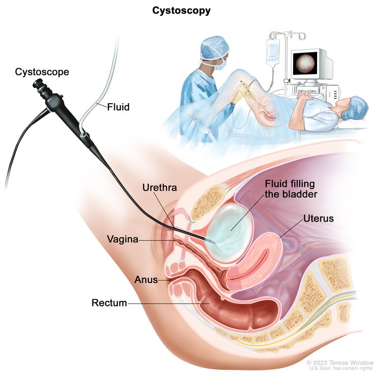 Bladder Cancer Diagnosis - NCI