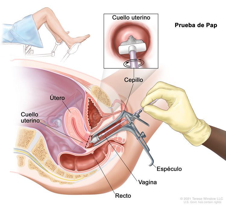 Prueba de Pap. En la imagen se observa una vista lateral anatómica del aparato reproductor femenino durante una prueba de Pap. Se observa un espéculo que ensancha la abertura de la vagina. Se muestra un cepillo que se introdujo en la vagina ensanchada y que toca el cuello uterino en la base del útero. También se observa el recto. En un recuadro, se observa el cepillo tocando el centro del cuello uterino. En la parte superior izquierda de la imagen, se muestra a una mujer cubierta por una sábana en una camilla que tiene las piernas separadas y los pies en los estribos.