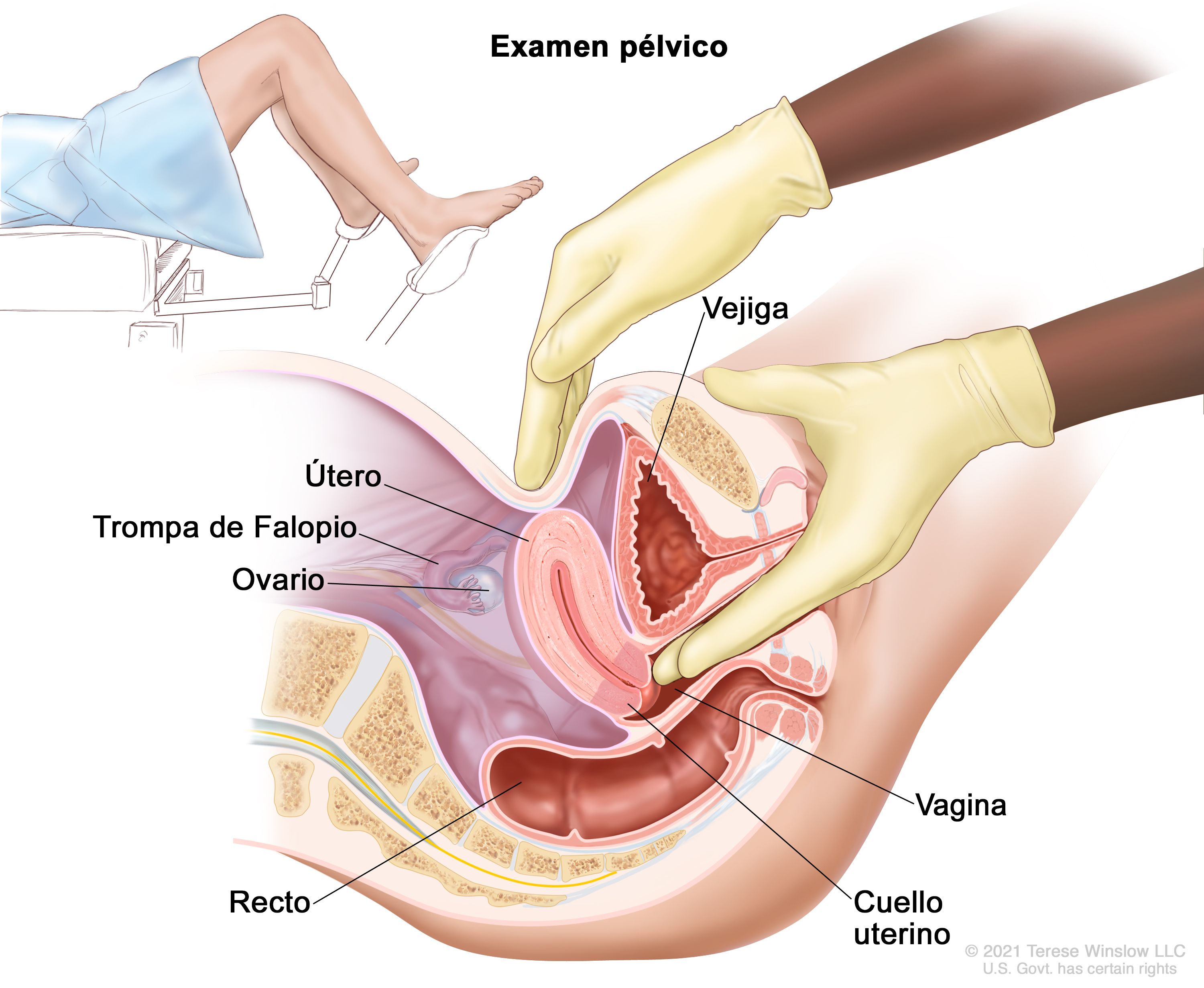 Cancer de vagina y vulva