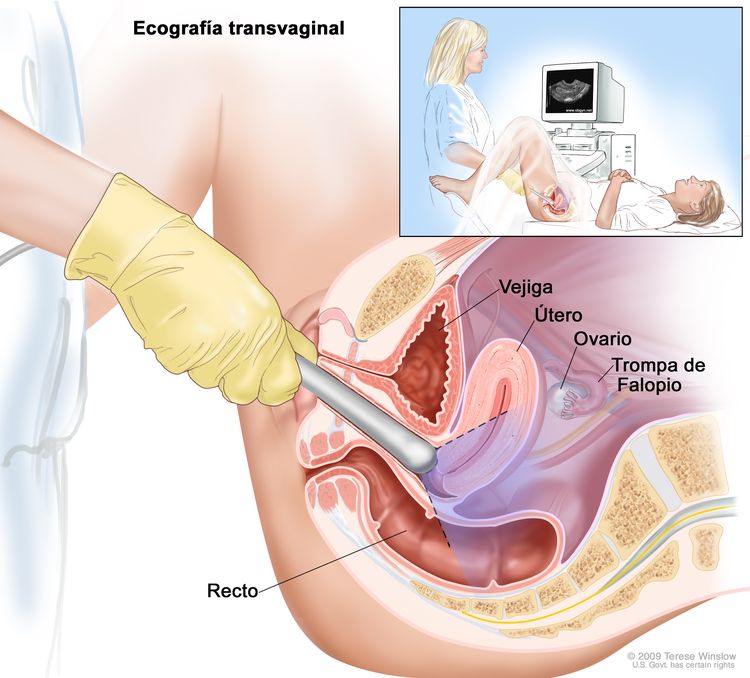 Después del diagnóstico de cáncer de vulva, se hacen pruebas para  determinar si las células cancerosas se diseminaron dentro de la vulva oa  otras partes del cuerpo.