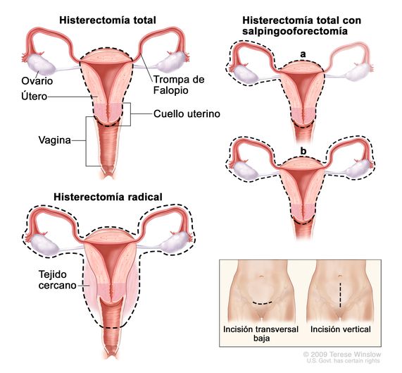 Ooforectomía O Retiro Quirúrgico Del Concepto Del Ovario O De Los