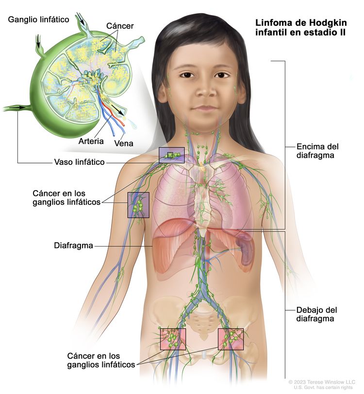 Linfoma de Hodgkin infantil en estadio II. En la imagen se observa cáncer en dos grupos de ganglios linfáticos encima y debajo del diafragma. En la ampliación se observa un ganglio linfático con un vaso linfático, una arteria y una vena. Dentro del ganglio linfático se muestran células cancerosas.