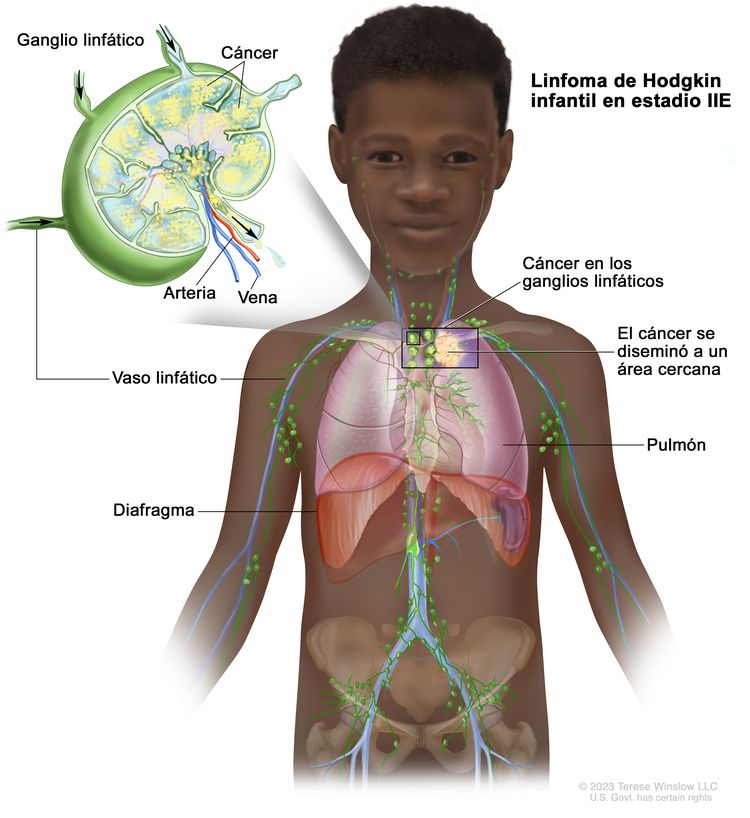 Linfoma de Hodgkin infantil en estadio IIE. En el dibujo se observa un niño que tiene cáncer en un grupo de ganglios linfáticos por encima del diafragma, y el cáncer se diseminó a un área cercana: el pulmón izquierdo. En la ampliación se muestra un ganglio linfático con un vaso linfático, una arteria y una vena. Dentro del ganglio linfático se observan células cancerosas.