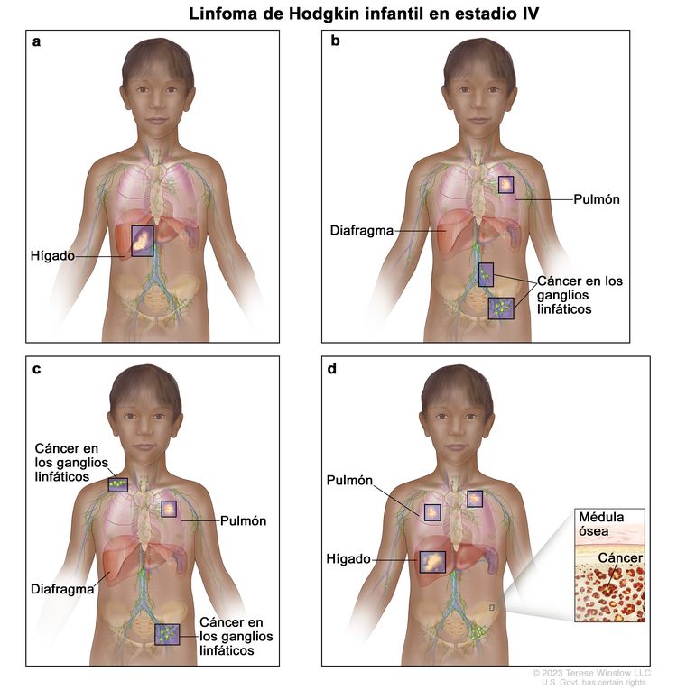 Linfoma de Hodgkin infantil en estadio IV. En la imagen se muestran cuatro paneles con dibujos de niños: en el panel superior izquierdo se observa el niño a) y se señala que tiene cáncer en el hígado; en el panel superior derecho se observa el niño b) y se señala que tiene cáncer en el pulmón izquierdo y en 2 grupos de ganglios linfáticos debajo del diafragma; en el panel inferior izquierdo se observa el niño c) y se señala que tiene cáncer en el pulmón izquierdo y en un grupo de ganglios linfáticos encima y debajo del diafragma; en el panel inferior derecho se observa el niño d) y se señala que tiene cáncer en ambos pulmones y en el hígado. Además en una ampliación se muestran células cancerosas en la médula ósea.